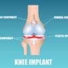 Knee Replacement Implants Market Is Set To Fly High Growth In Years To Come