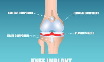 Knee Replacement Implants Market Is Set To Fly High Growth In Years To Come